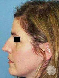 Woman before nose job - Nashville TN