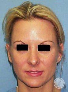 Woman after nose job - Nashville