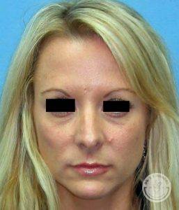 Woman before nose job - Nashville TN