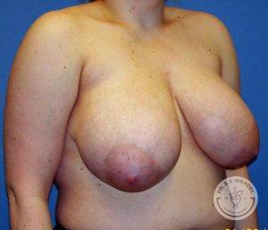 Woman before Breast Reduction Surgery Nashville TN