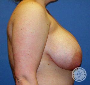 Woman before Breast Reduction Surgery Nashville TN