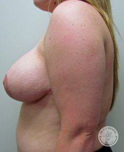 Woman after Breast Reduction Surgery Nashville TN
