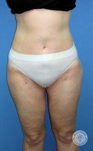 Woman liposuction after Nashville