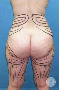 Woman liposuction before Nashville