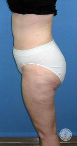 Woman liposuction after Nashville