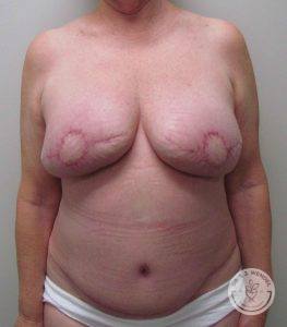 DIEP Flap Breast Reconstruction Nashville