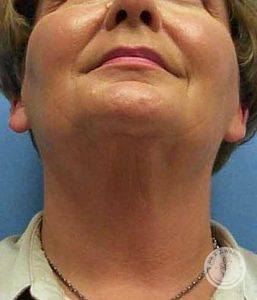 Woman after neck liposuction Nashville