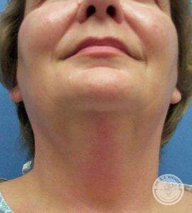 Woman before neck liposuction Nashville