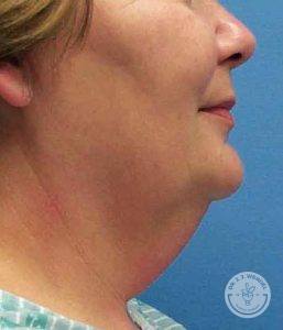 Woman before neck liposuction Nashville