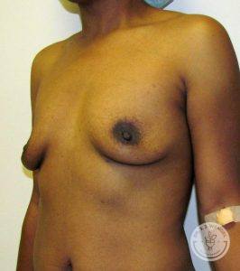 Silicone breast implants Nashville