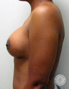 Silicone breast implants Nashville