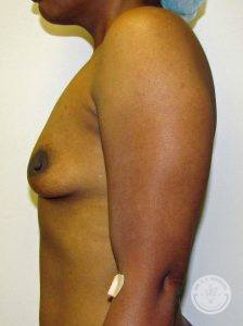 Silicone breast implants Nashville