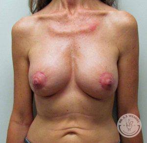 Woman after Breast Lift Nashville