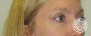 Woman after eyelid surgery Nashville