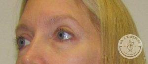 Woman after eyelid surgery Nashville