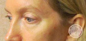 Woman before eyelid surgery Nashville