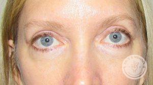 Woman after eyelid surgery Nashville