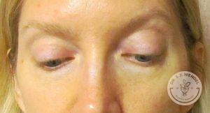 Woman before eyelid surgery Nashville