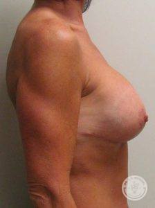 Breast Lift Surgery