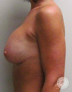 Breast Lift Surgery