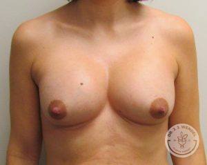 Silicone breast implants Nashville