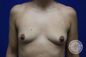 Silicone breast implants Nashville