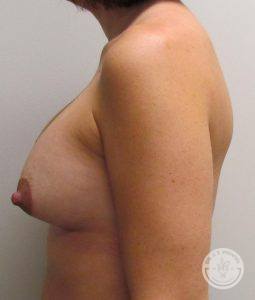 Silicone breast implants Nashville
