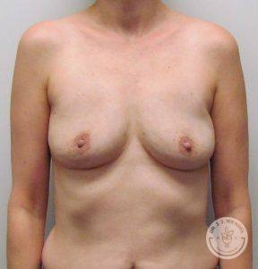 Natural Breast Augmentation Nashville