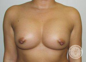 Silicone breast implants Nashville