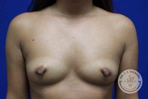 Silicone breast implants Nashville