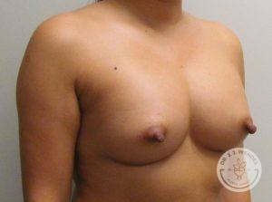 Silicone breast implants Nashville