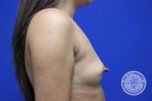 Silicone breast implants Nashville