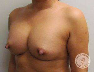 Silicone breast implants Nashville