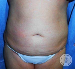 Woman before after tummy tuck Nashville tn