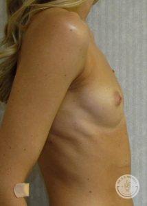 Silicone breast implants Nashville