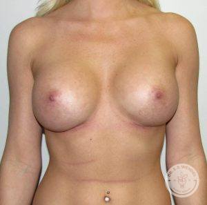 Silicone breast implants Nashville