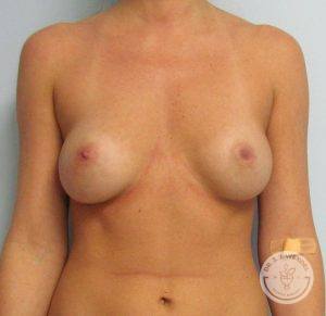 Silicone breast implants Nashville