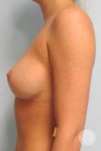 Silicone breast implants Nashville