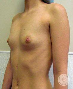 Woman before after Silicone breast implants Nashville TN