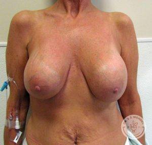 Breast Augmentation with Lift Nashville