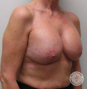 Breast Augmentation with Lift Nashville
