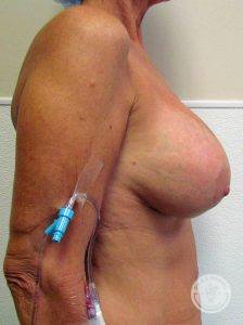 Breast Augmentation with Lift Nashville