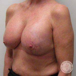 Breast Augmentation with Lift Nashville