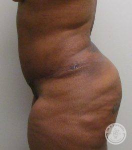 Woman before after tummy tuck Nashville TN