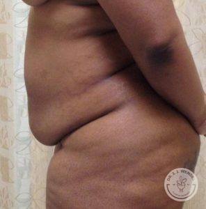 Woman before after tummy tuck Nashville TN