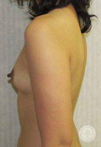 Woman before after Silicone breast implants Nashville TN