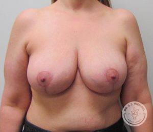 After breast reduction Nashville