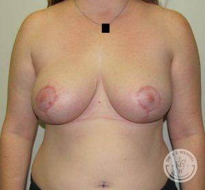 Before After Breast Reduction Nashville Tennessee