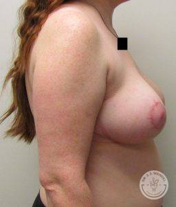 Before After Breast Reduction Nashville Tennessee