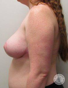 Before After Breast Reduction Nashville Tennessee